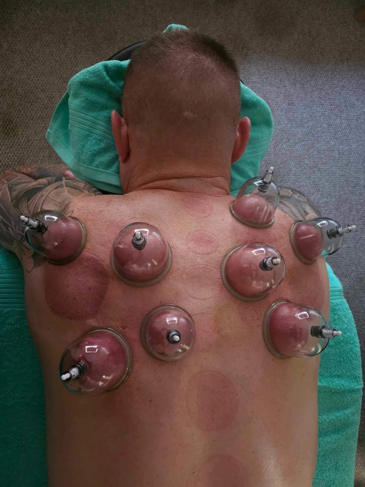 Cupping Therapy: What It Is and Who It May Help — Massages By Sarah